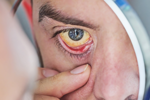 Image of someone with hepatitis